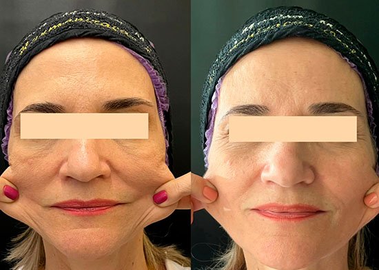 BIOESTIMULADOR DE COLÁGENO - Consultório Dra Marisa Mancilha