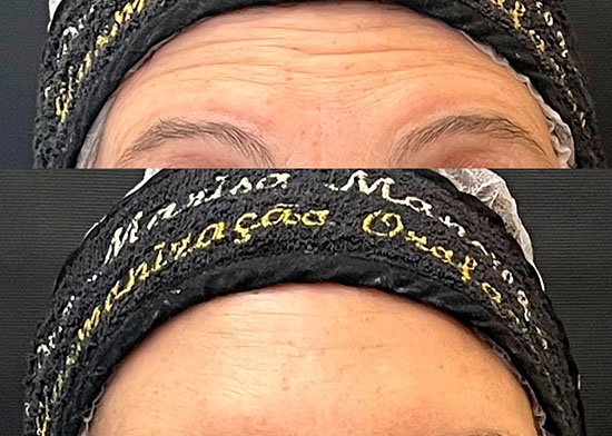 Botox - Consultório Dra Marisa Mancilha