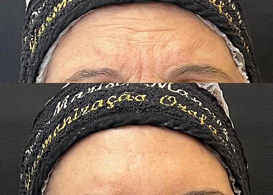 Botox - Consultório Dra Marisa Mancilha
